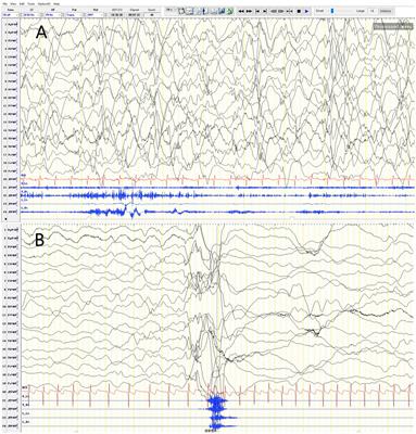 New evidence supports RYR3 as a candidate gene for developmental and epileptic encephalopathy